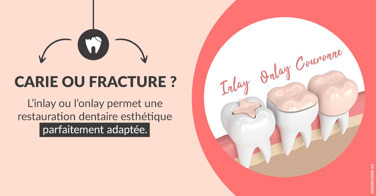 https://dr-hueber-veronique.chirurgiens-dentistes.fr/T2 2023 - Carie ou fracture 2