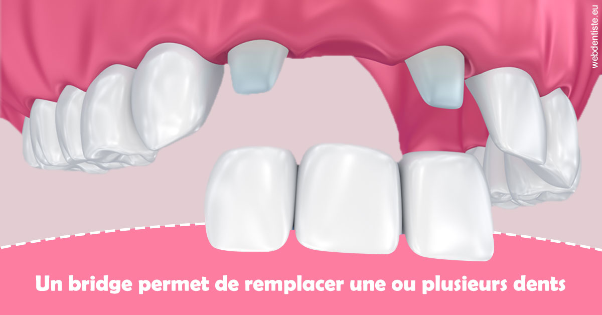 https://dr-hueber-veronique.chirurgiens-dentistes.fr/Bridge remplacer dents 2