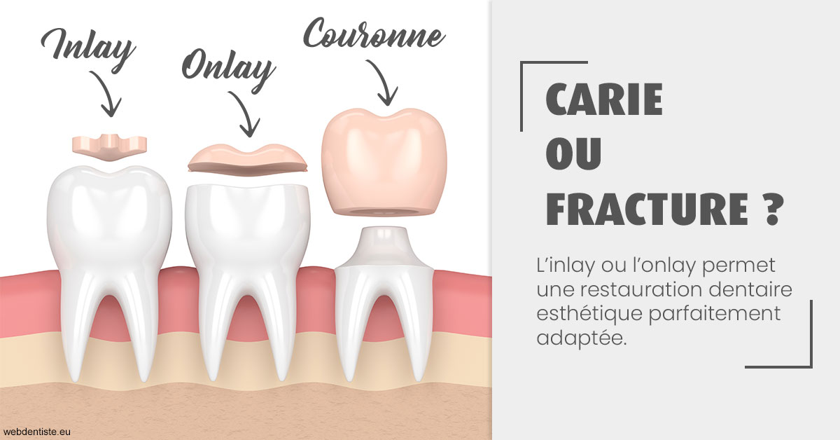 https://dr-hueber-veronique.chirurgiens-dentistes.fr/T2 2023 - Carie ou fracture 1