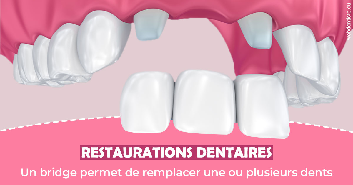 https://dr-hueber-veronique.chirurgiens-dentistes.fr/Bridge remplacer dents 2