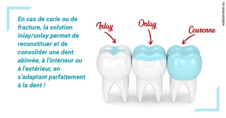 https://dr-hueber-veronique.chirurgiens-dentistes.fr/L'INLAY ou l'ONLAY