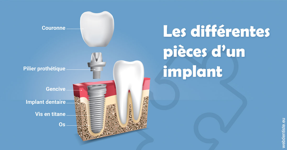 https://dr-hueber-veronique.chirurgiens-dentistes.fr/Les différentes pièces d’un implant 1